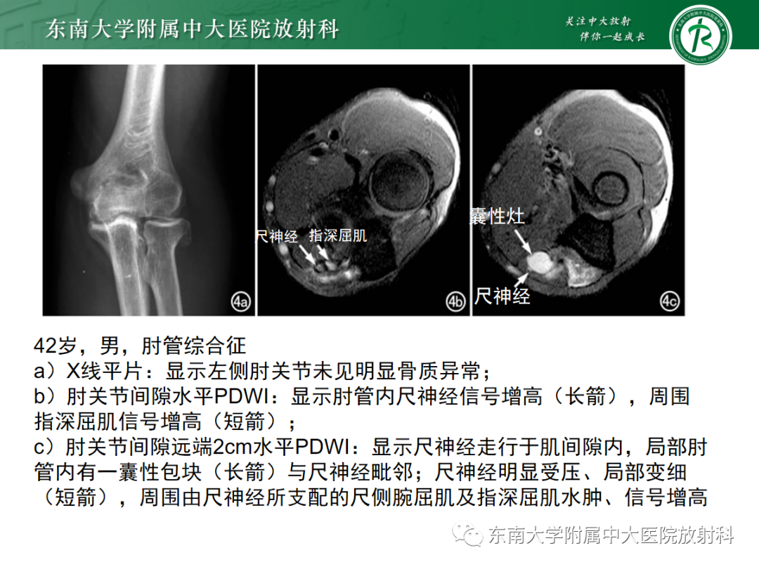 影像PPT - 【PPT】肘管综合征-23