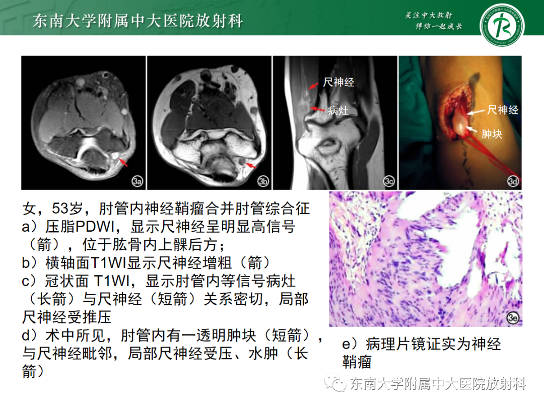 影像PPT - 【PPT】肘管综合征-24