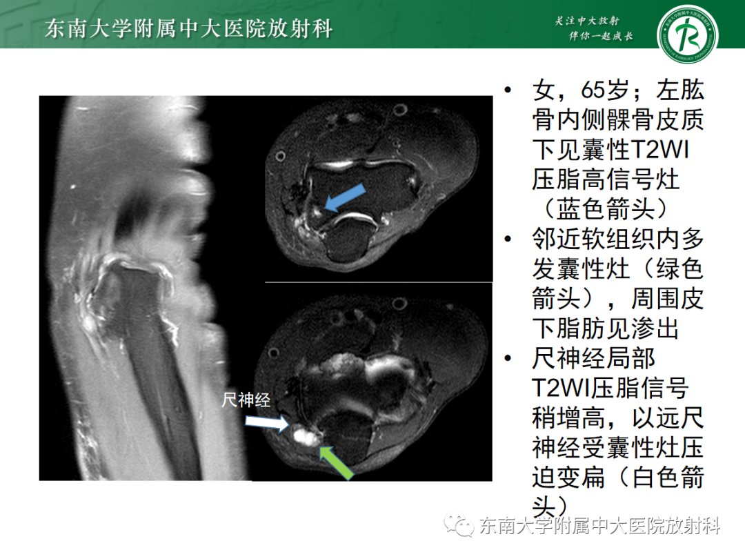 影像PPT - 【PPT】肘管综合征-25
