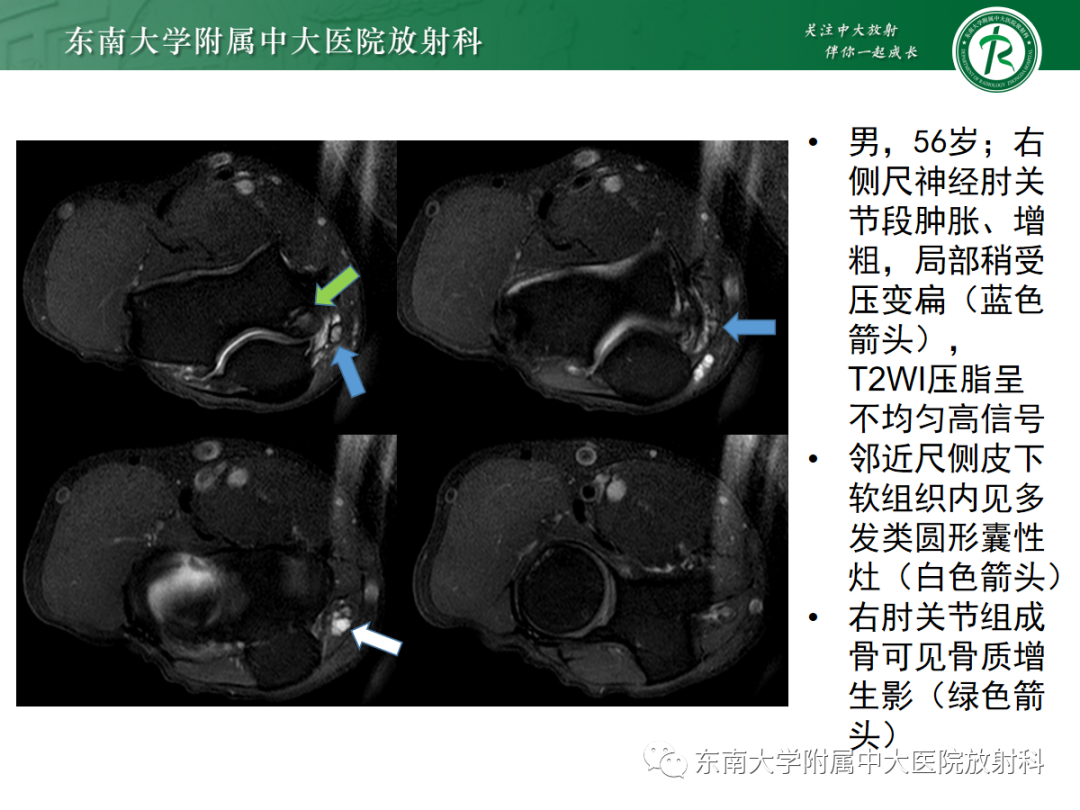 影像PPT - 【PPT】肘管综合征-26