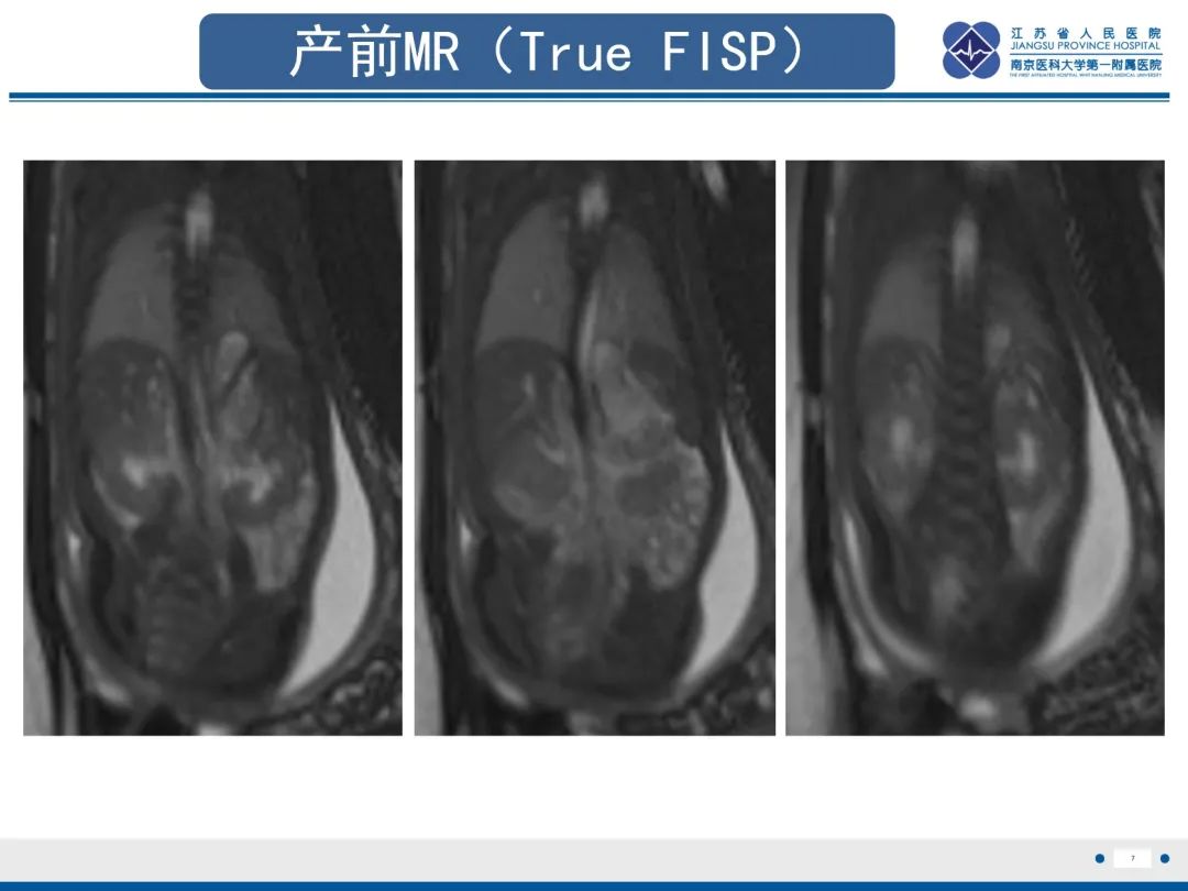 影像PPT - 【PPT】胎儿支气管肺隔离症-8