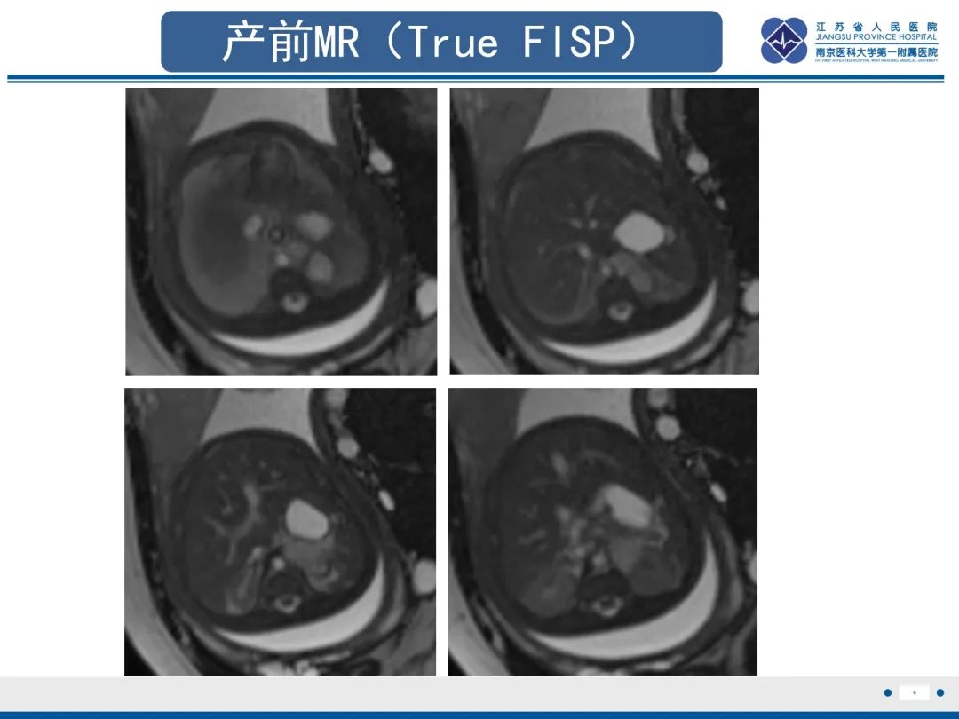 影像PPT - 【PPT】胎儿支气管肺隔离症-7