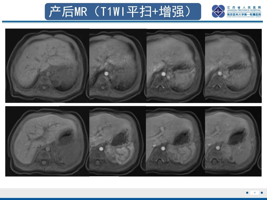 影像PPT - 【PPT】胎儿支气管肺隔离症-13