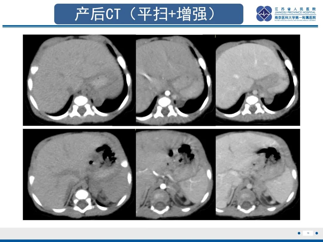 影像PPT - 【PPT】胎儿支气管肺隔离症-14