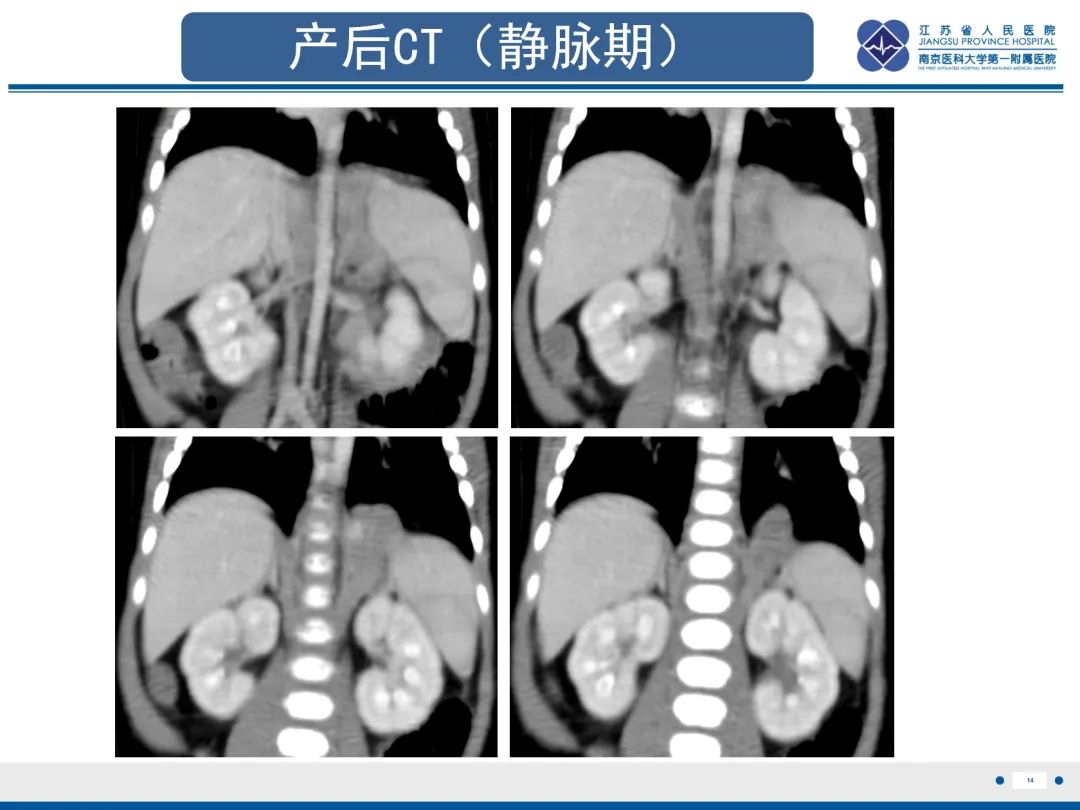 影像PPT - 【PPT】胎儿支气管肺隔离症-15