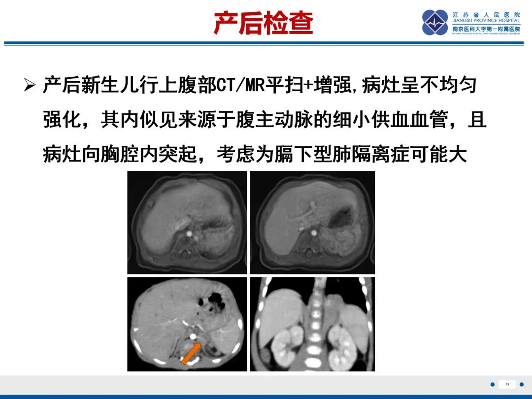 影像PPT - 【PPT】胎儿支气管肺隔离症-20
