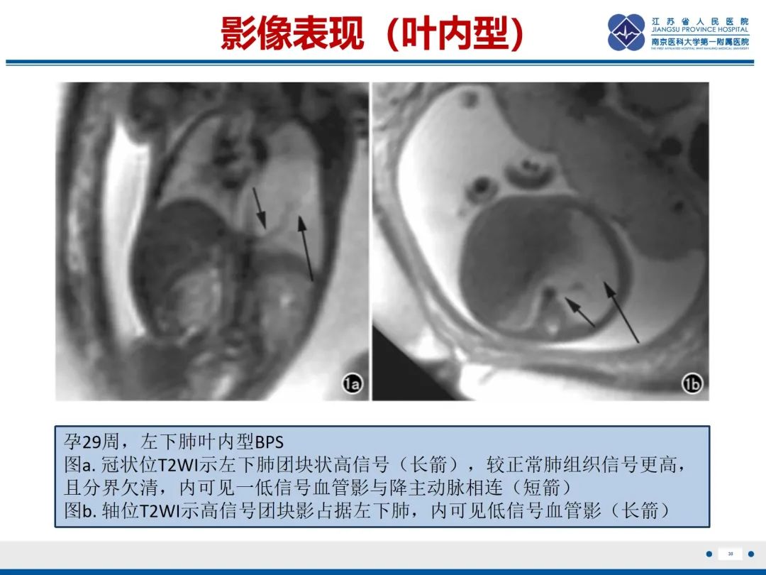 影像PPT - 【PPT】胎儿支气管肺隔离症-31