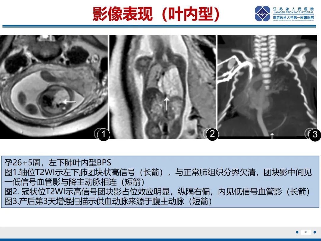 影像PPT - 【PPT】胎儿支气管肺隔离症-32