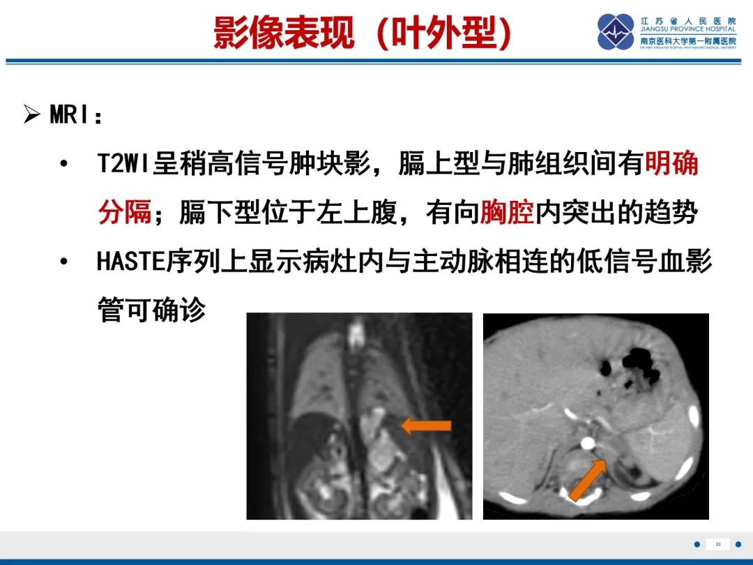 影像PPT - 【PPT】胎儿支气管肺隔离症-34