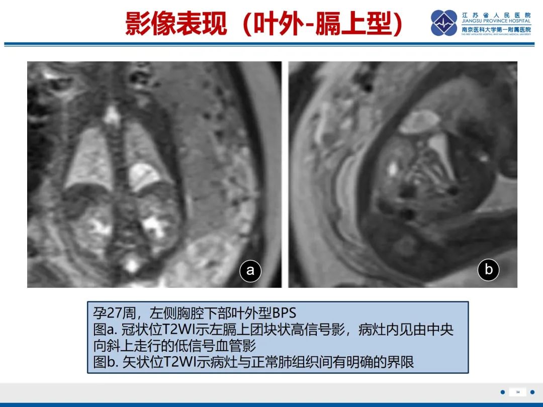 影像PPT - 【PPT】胎儿支气管肺隔离症-35