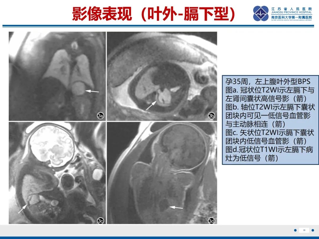 影像PPT - 【PPT】胎儿支气管肺隔离症-36