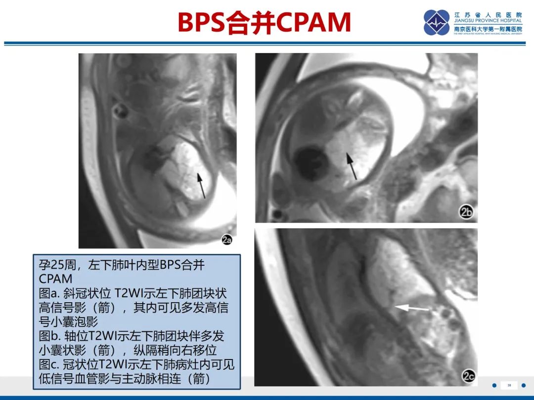 影像PPT - 【PPT】胎儿支气管肺隔离症-39