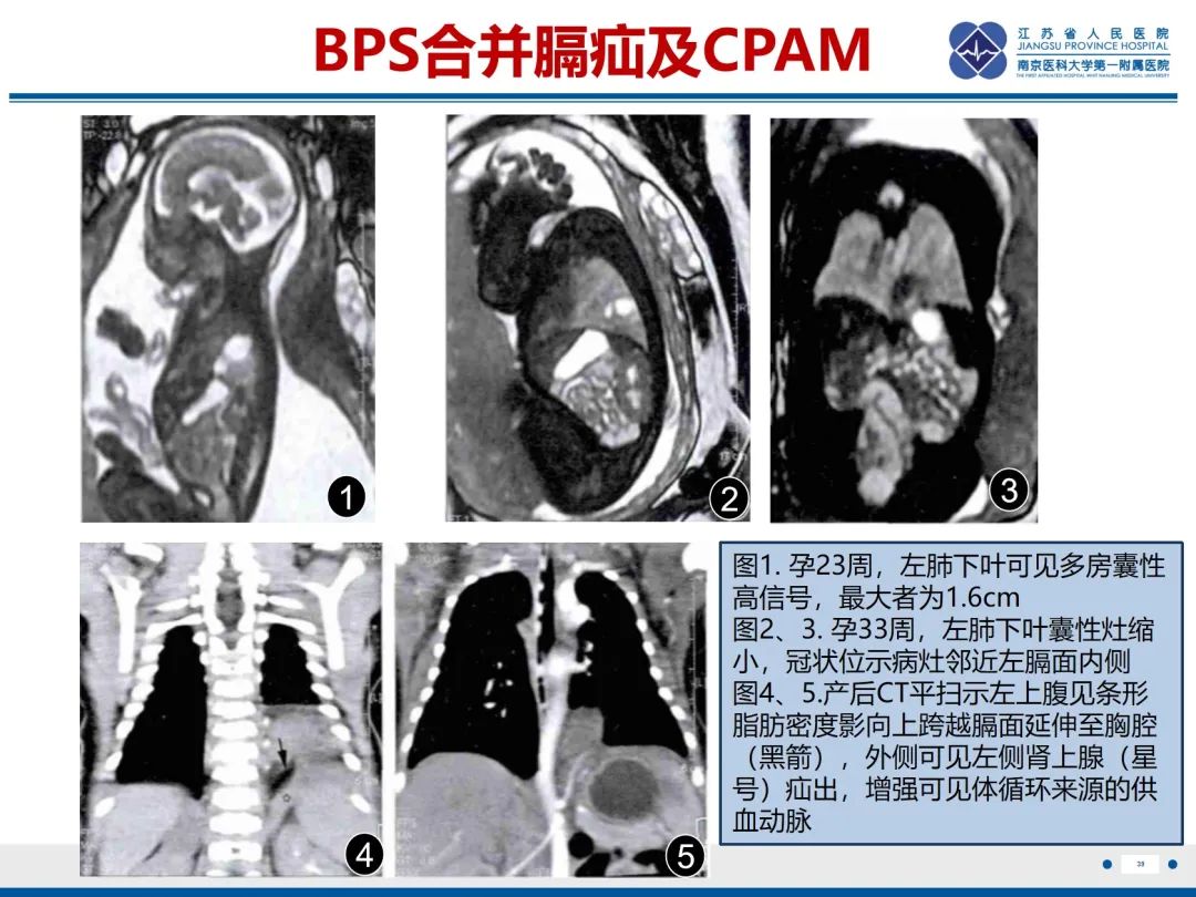 影像PPT - 【PPT】胎儿支气管肺隔离症-40