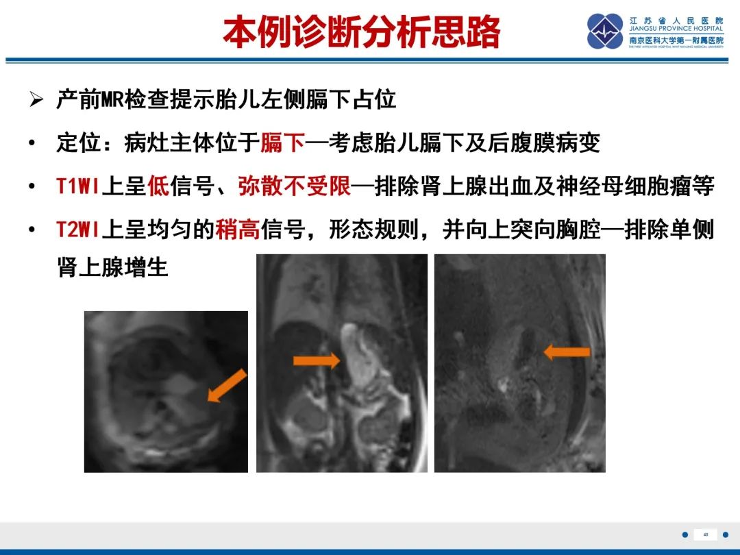 影像PPT - 【PPT】胎儿支气管肺隔离症-41