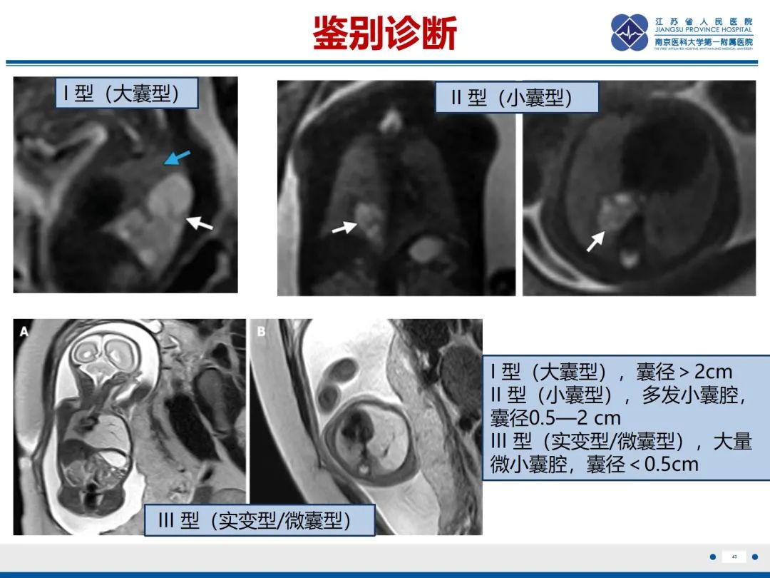影像PPT - 【PPT】胎儿支气管肺隔离症-44