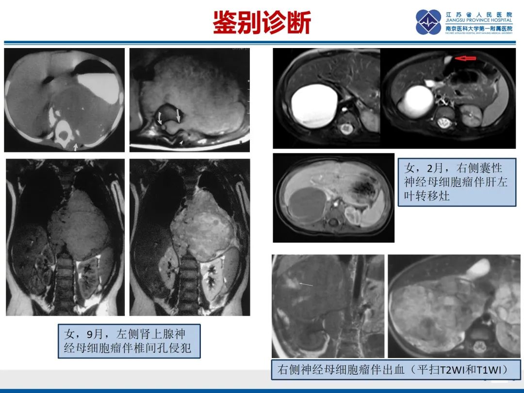 影像PPT - 【PPT】胎儿支气管肺隔离症-46