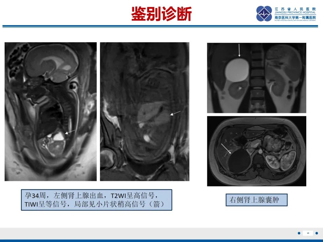 影像PPT - 【PPT】胎儿支气管肺隔离症-47