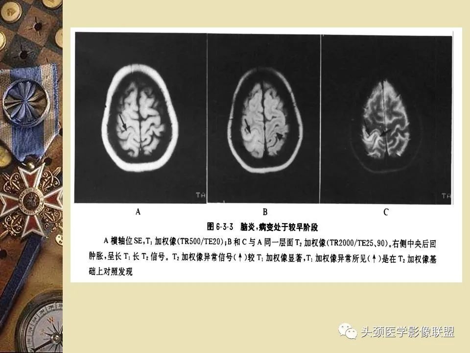 影像PPT - 【PPT】脑部病变的MRI诊断-11