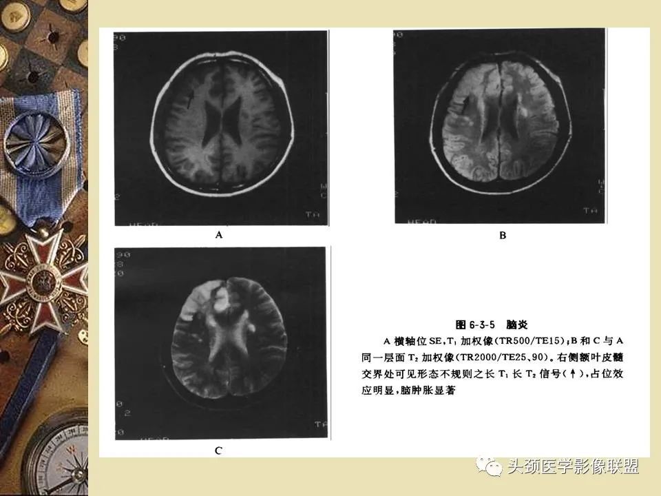 影像PPT - 【PPT】脑部病变的MRI诊断-12