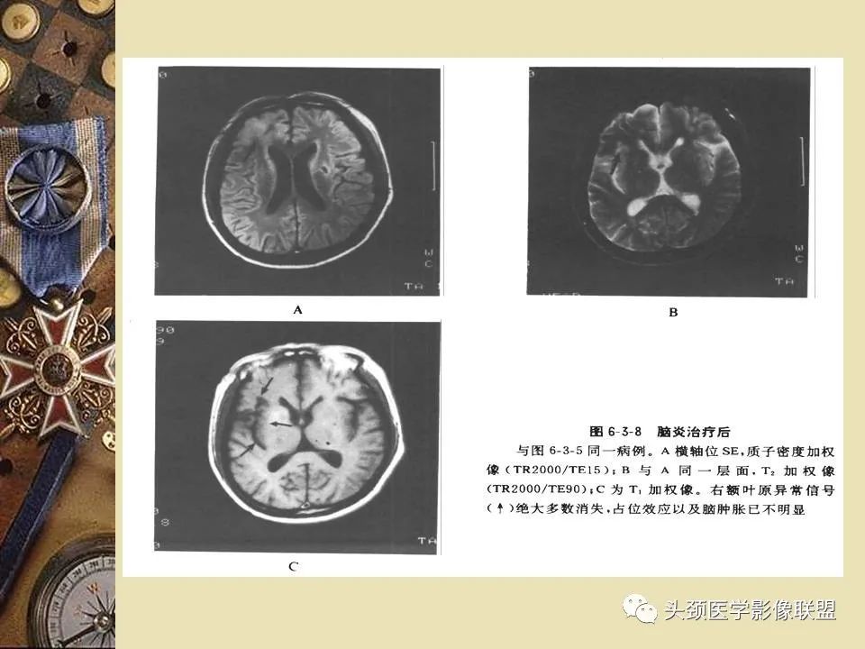 影像PPT - 【PPT】脑部病变的MRI诊断-13