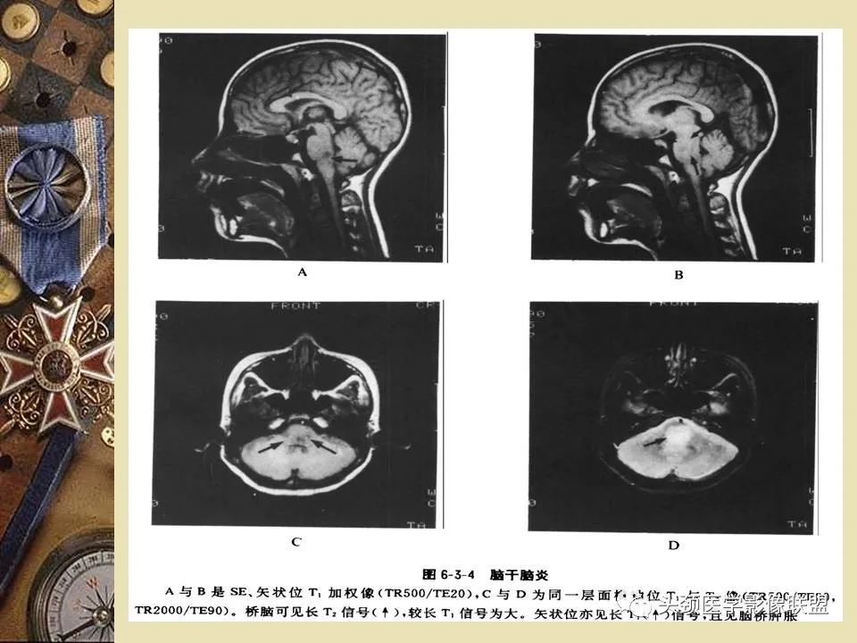 影像PPT - 【PPT】脑部病变的MRI诊断-14