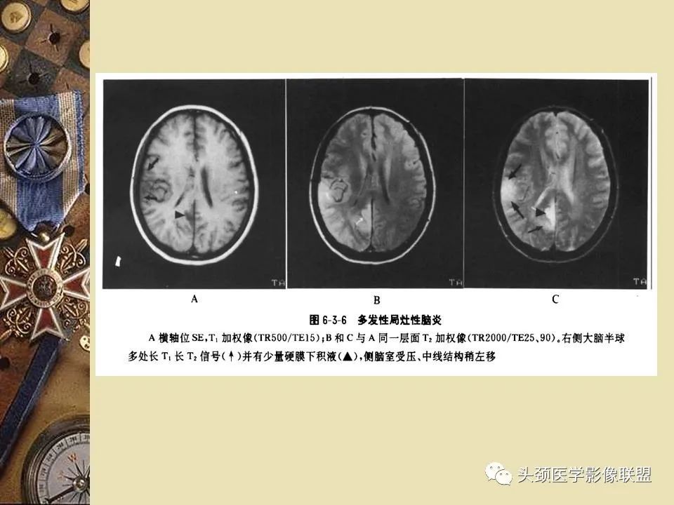 影像PPT - 【PPT】脑部病变的MRI诊断-15