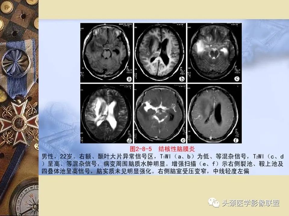 影像PPT - 【PPT】脑部病变的MRI诊断-17