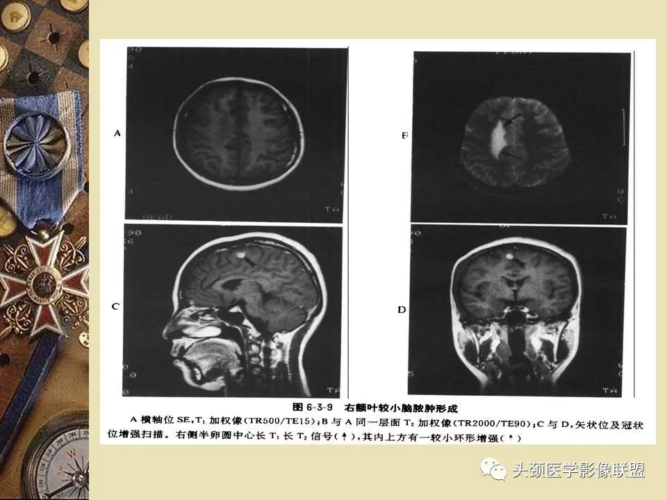 影像PPT - 【PPT】脑部病变的MRI诊断-22