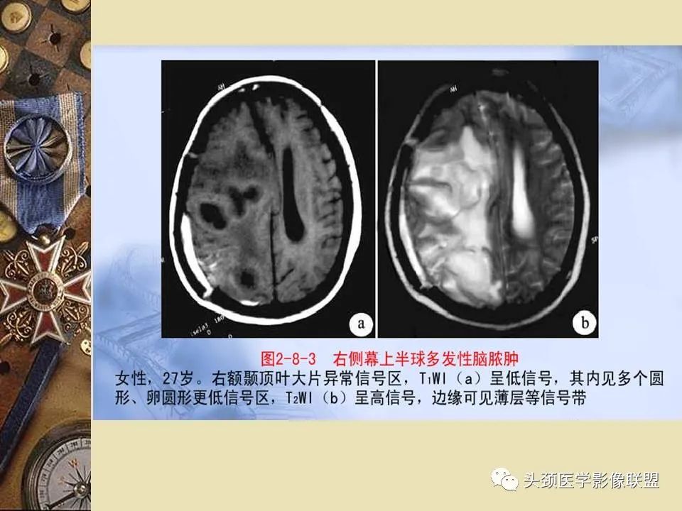 影像PPT - 【PPT】脑部病变的MRI诊断-23