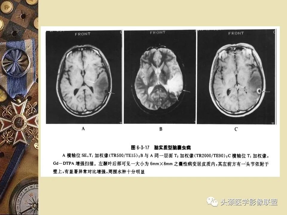 影像PPT - 【PPT】脑部病变的MRI诊断-28
