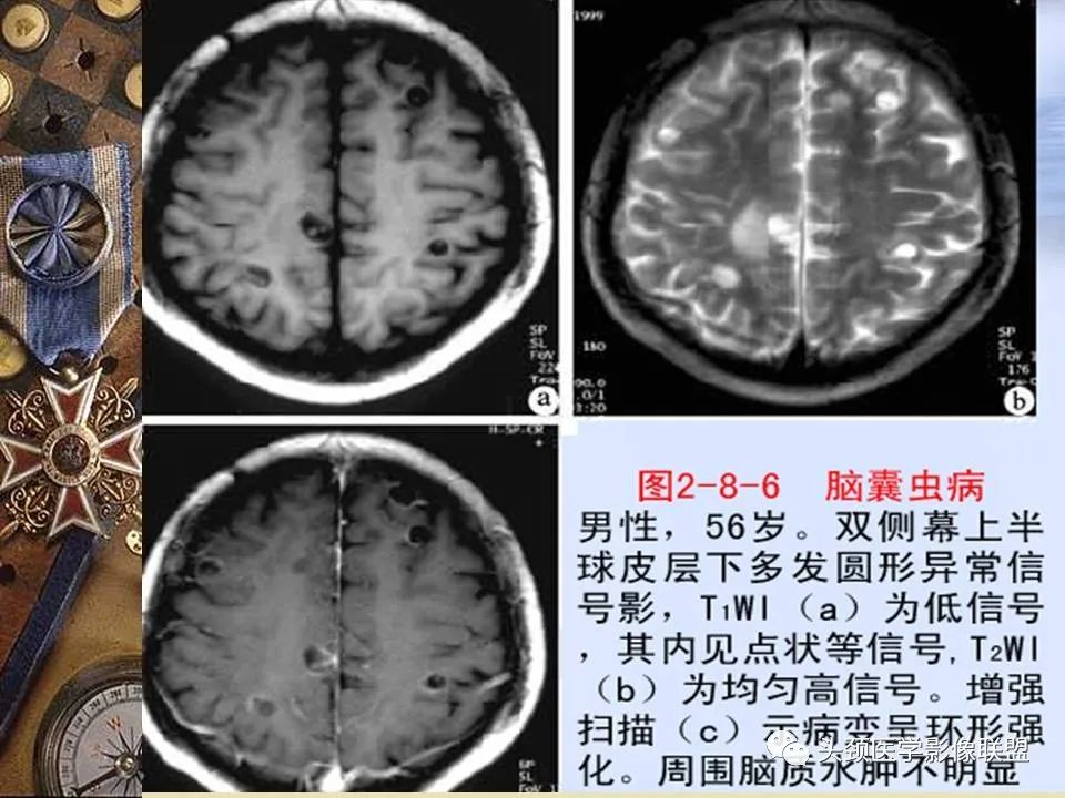 影像PPT - 【PPT】脑部病变的MRI诊断-30