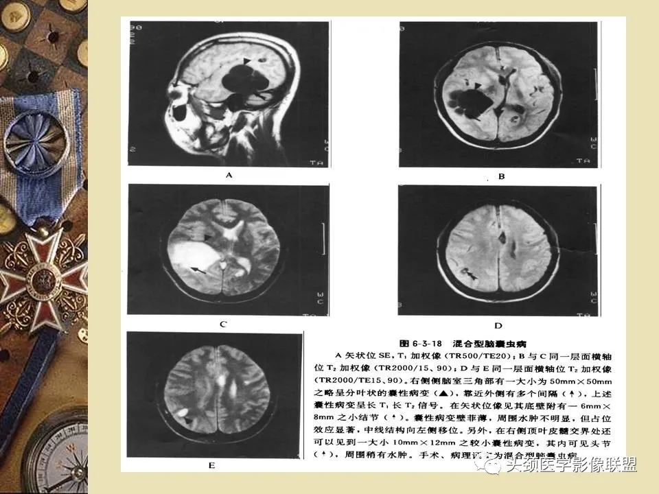 影像PPT - 【PPT】脑部病变的MRI诊断-31