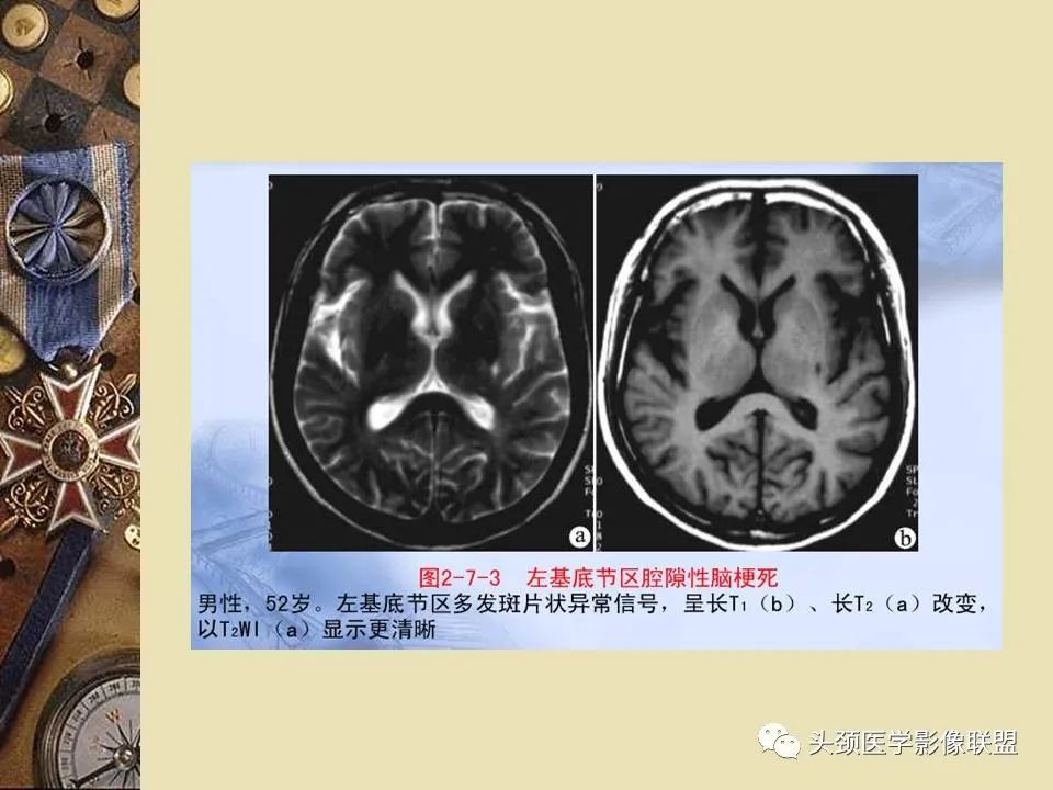 影像PPT - 【PPT】脑部病变的MRI诊断-46