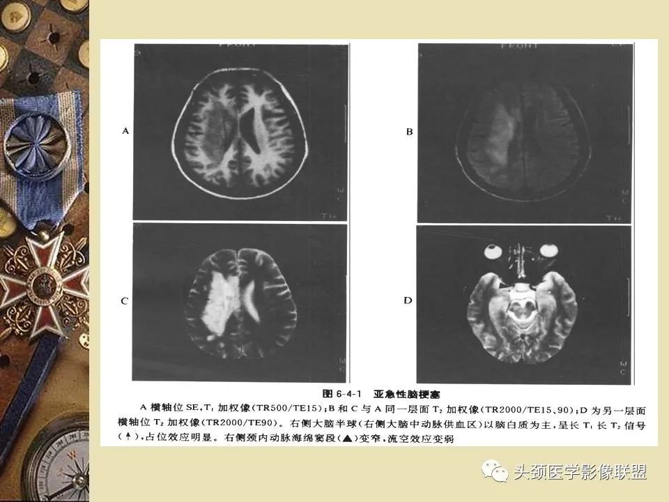 影像PPT - 【PPT】脑部病变的MRI诊断-47