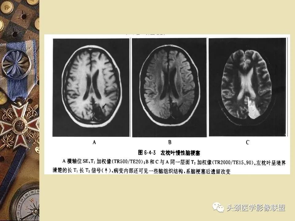 影像PPT - 【PPT】脑部病变的MRI诊断-49