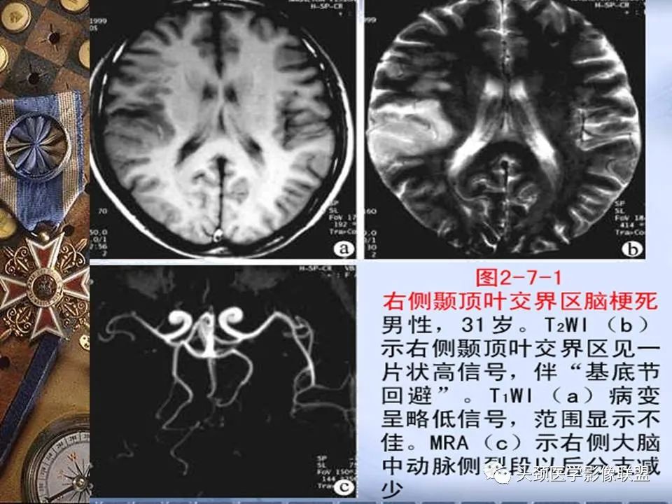 影像PPT - 【PPT】脑部病变的MRI诊断-50