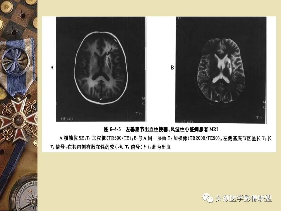 影像PPT - 【PPT】脑部病变的MRI诊断-52