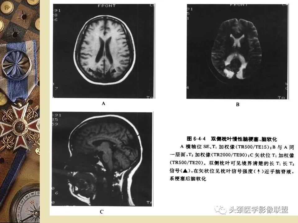 影像PPT - 【PPT】脑部病变的MRI诊断-51