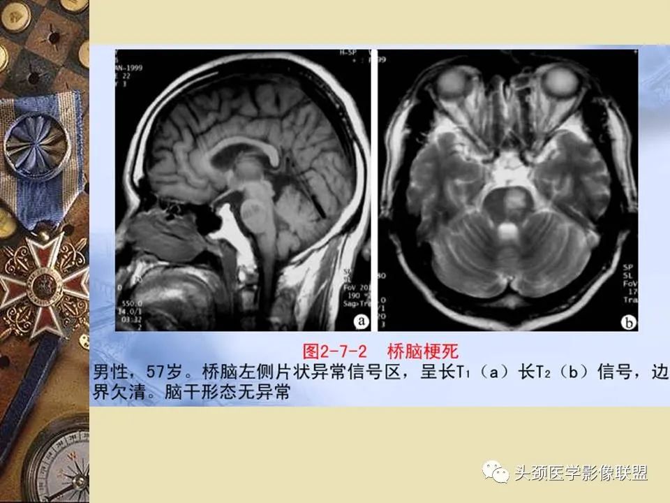 影像PPT - 【PPT】脑部病变的MRI诊断-53