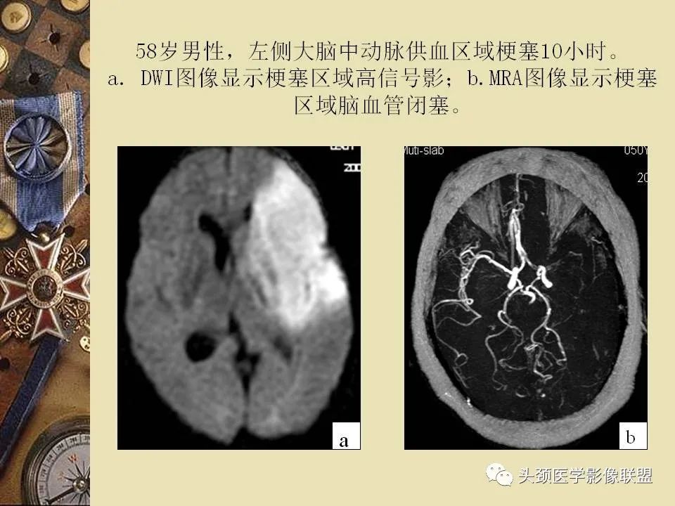 影像PPT - 【PPT】脑部病变的MRI诊断-54