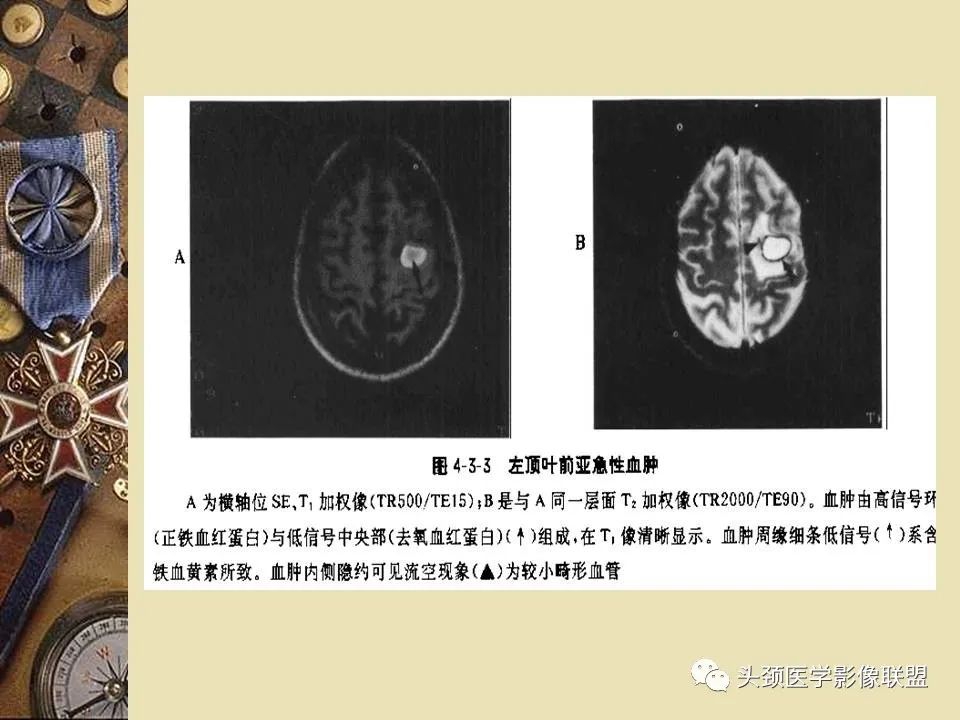 影像PPT - 【PPT】脑部病变的MRI诊断-64