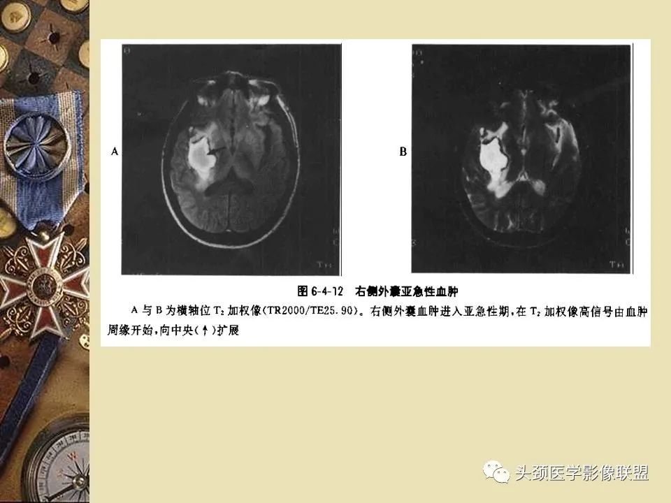 影像PPT - 【PPT】脑部病变的MRI诊断-65