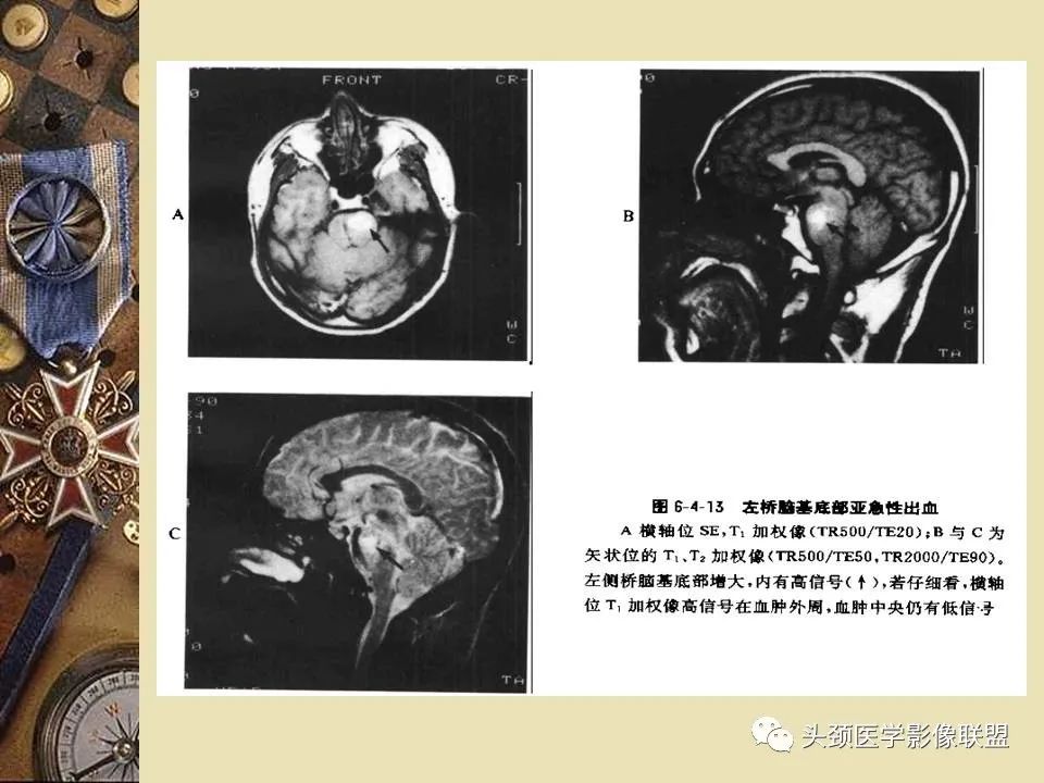 影像PPT - 【PPT】脑部病变的MRI诊断-67