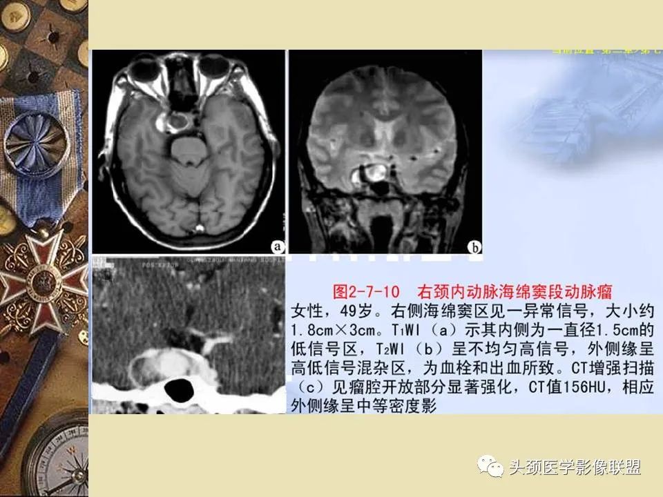 影像PPT - 【PPT】脑部病变的MRI诊断-75