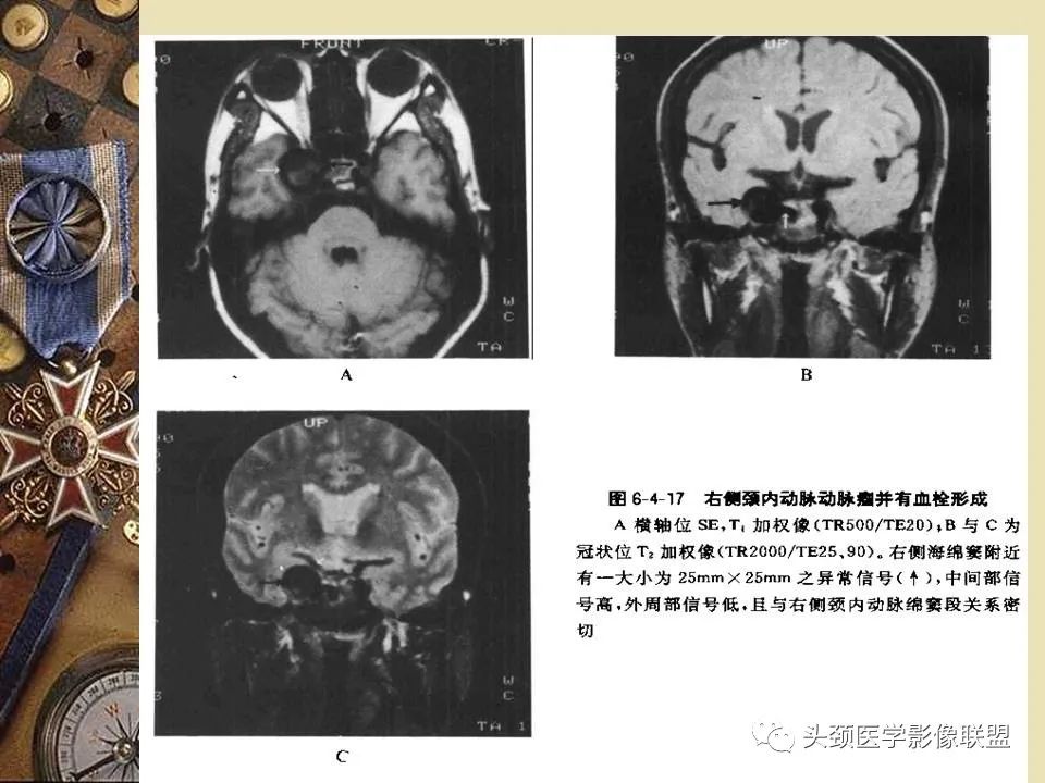 影像PPT - 【PPT】脑部病变的MRI诊断-76