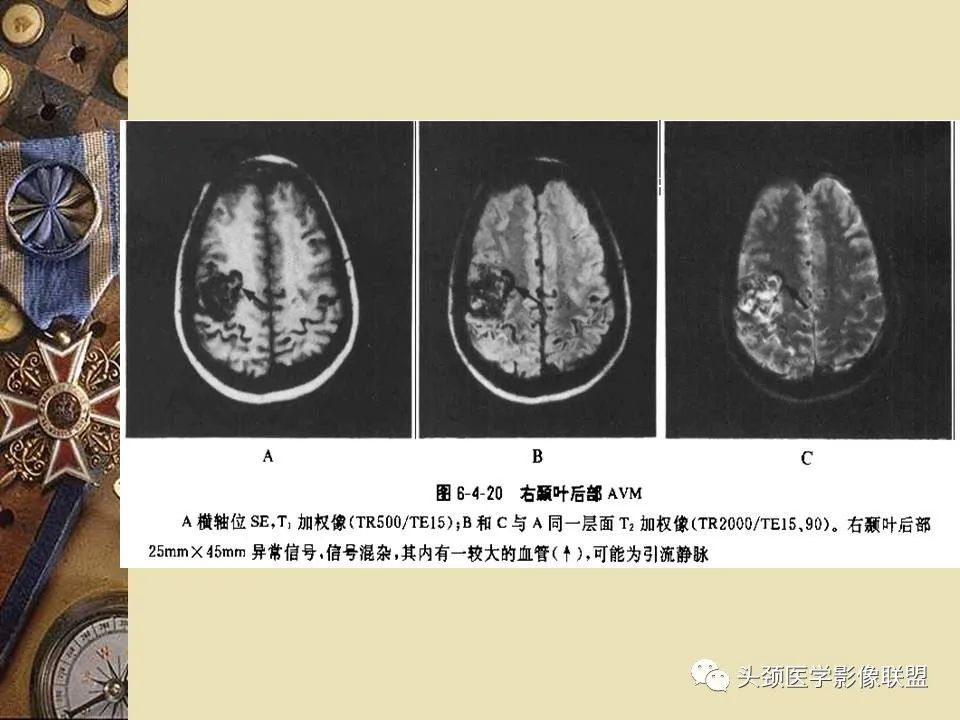 影像PPT - 【PPT】脑部病变的MRI诊断-83