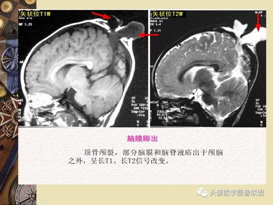 影像PPT - 【PPT】脑部病变的MRI诊断-90