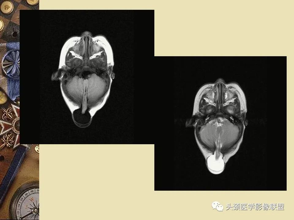 影像PPT - 【PPT】脑部病变的MRI诊断-92