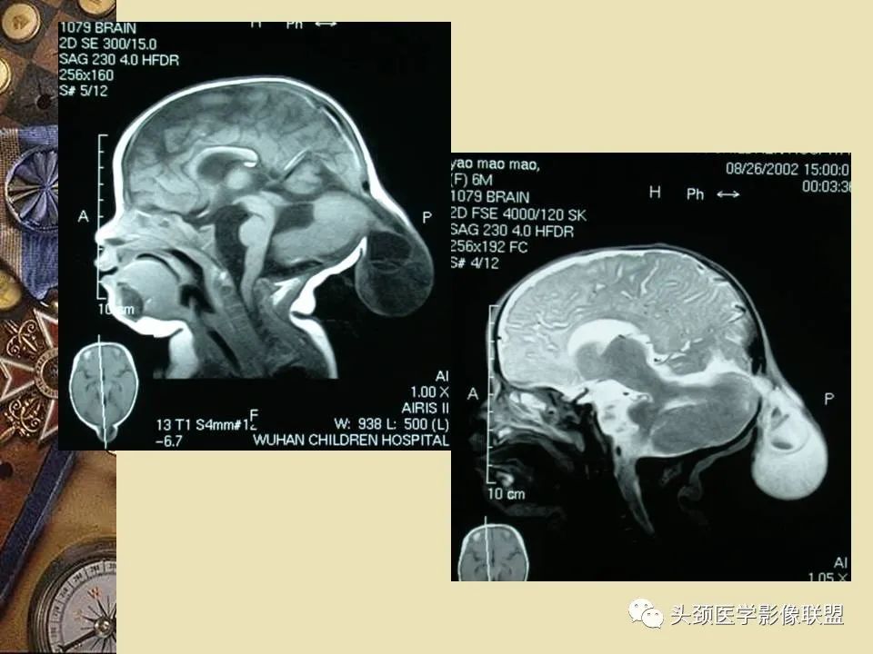 影像PPT - 【PPT】脑部病变的MRI诊断-93