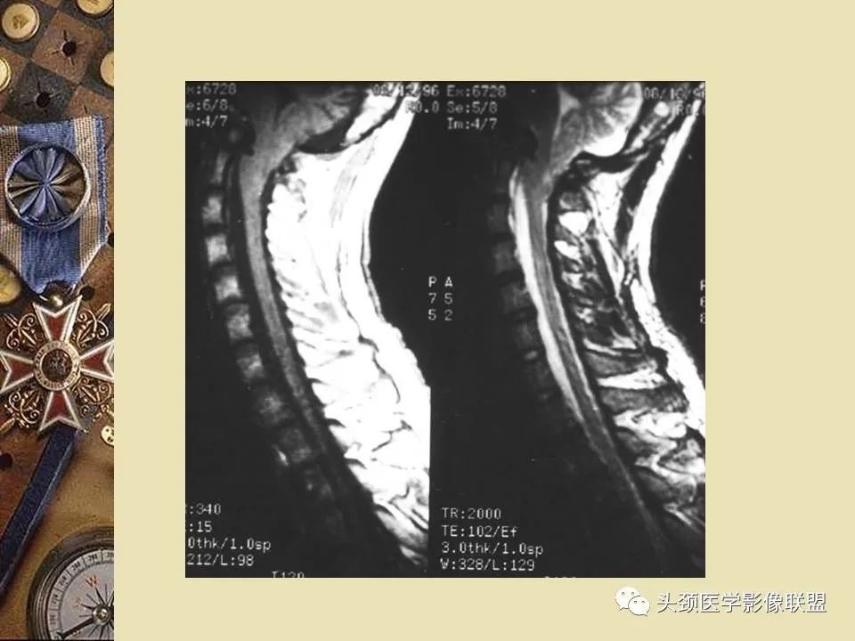 影像PPT - 【PPT】脑部病变的MRI诊断-95